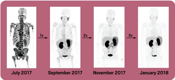 FARMACI RADIOATTIVI MIRATI (RADIOFARMACI) ALIMENTANO SPERANZE PER LA CURA DEL CANCRO (2 di 2).